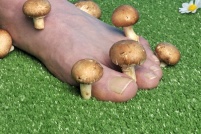 Frühes Stadium: Der Nagel weist an der Spitze eine weiss-graue Verfärbung auf. In dieser frühen Phase bestehen gute Heilungschancen. Versuchen Sie es zunächst mit einer natürlichen Teebaumöltherapie oder – falls das nicht ausreicht – mit einer stärkeren, pilzhemmenden Creme.