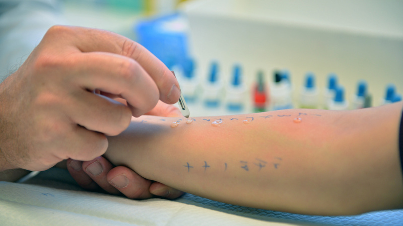 Heuschnupfen, Allergie, Pollenallergie: Nackter, mit Zahlen beschriebener Untrarm, die Hand eines Arztes sticht mit einer feinen Nadel hinein