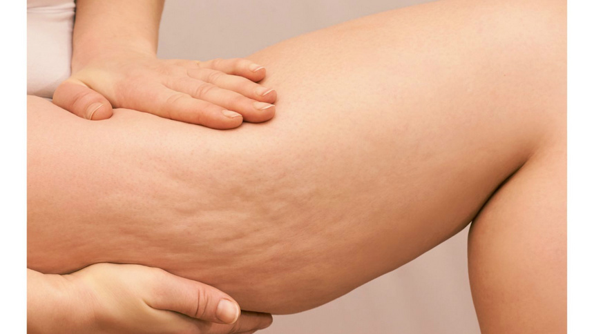 Schönheit, Pflege, Haut, Orangenhaut, Cellulite.